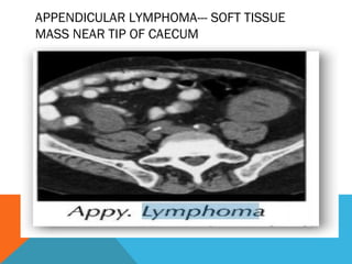 APPENDICULAR LYMPHOMA--- SOFT TISSUE
MASS NEAR TIP OF CAECUM
 