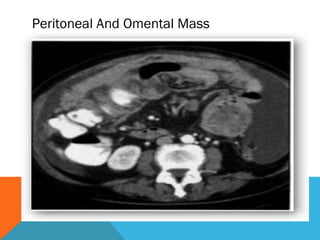Peritoneal And Omental Mass
 