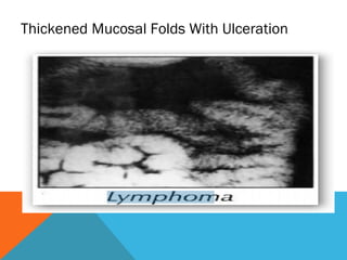 Thickened Mucosal Folds With Ulceration
 