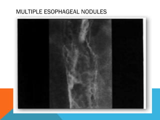 MULTIPLE ESOPHAGEAL NODULES
 