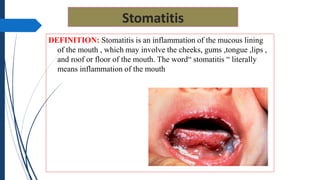 Stomatitis
DEFINITION: Stomatitis is an inflammation of the mucous lining
of the mouth , which may involve the cheeks, gums ,tongue ,lips ,
and roof or floor of the mouth. The word“ stomatitis “ literally
means inflammation of the mouth
 