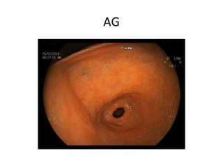 GIT new endoscopic pictures. | PPT