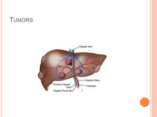 TUMORS
 