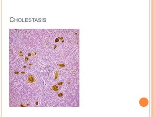 CHOLESTASIS
 
