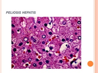 PELIOSIS HEPATIS
 