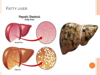FATTY LIVER
 