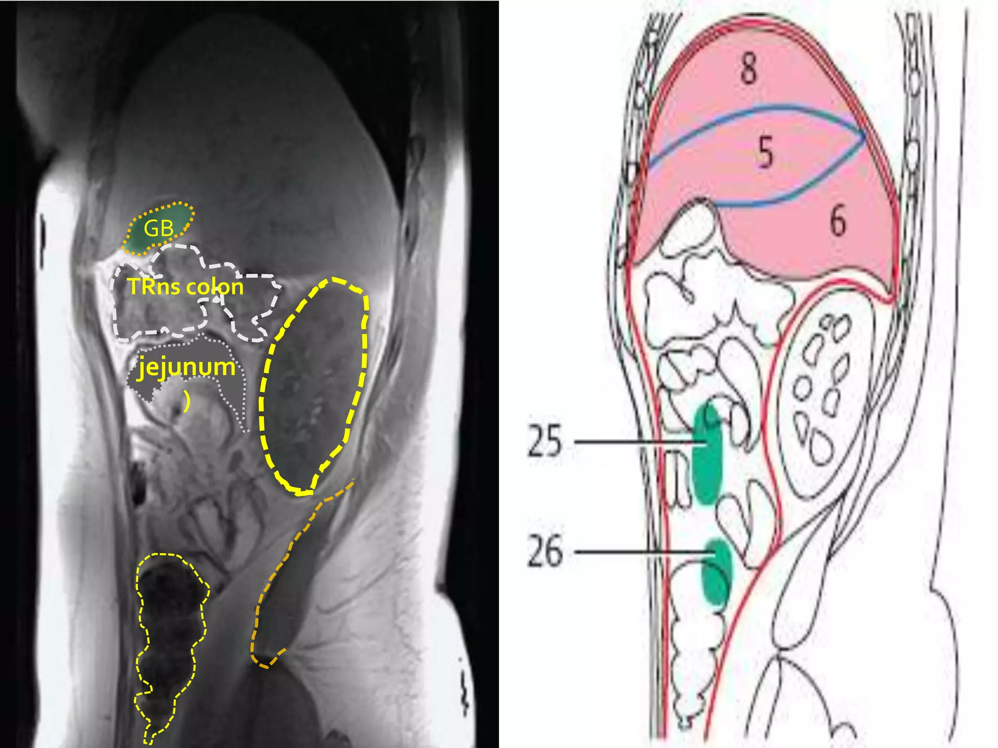 GB

TRns colon


jejunum
    )
 