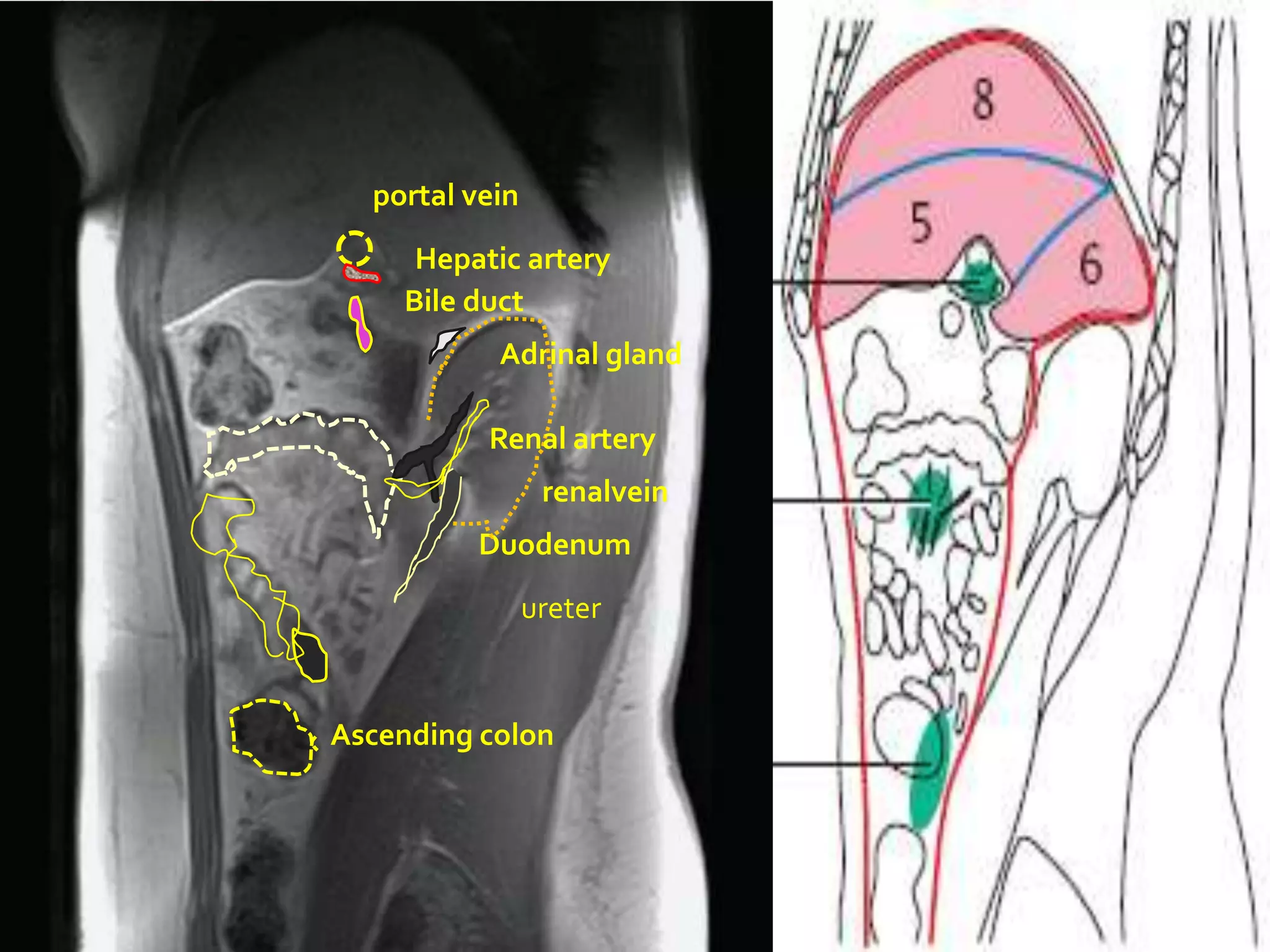 `
      portal vein

         Hepatic artery
        Bile duct
               Adrinal gland

              Renal artery
                     renalvein
             Duodenum
                    ureter



    Ascending colon
 
