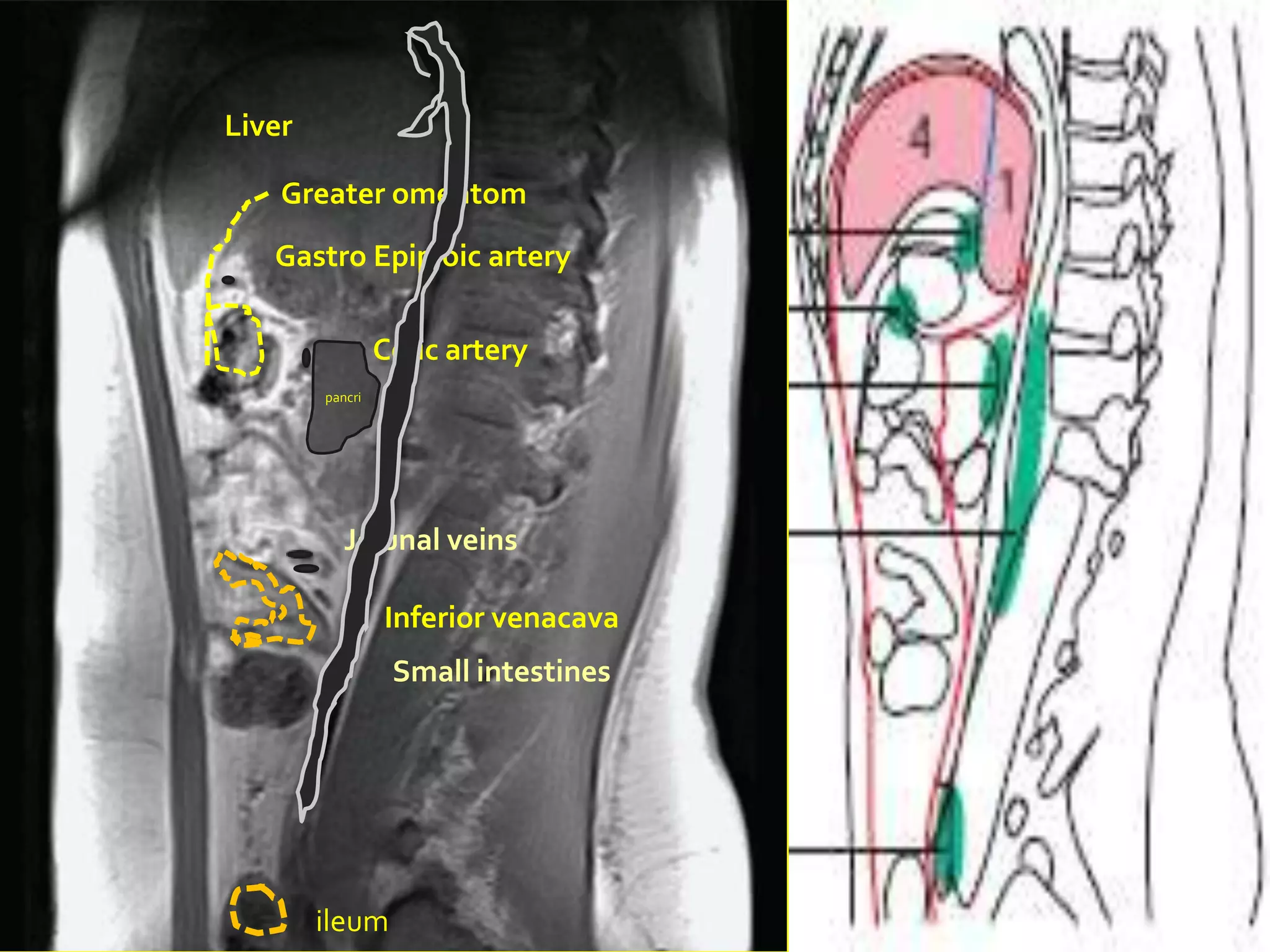 Liver

    Greater omentom
   Gastro Epiploic artery

                 Colic artery
        pancri




           Jejunal veins

                 Inferior venacava
                  Small intestines




        ileum
 