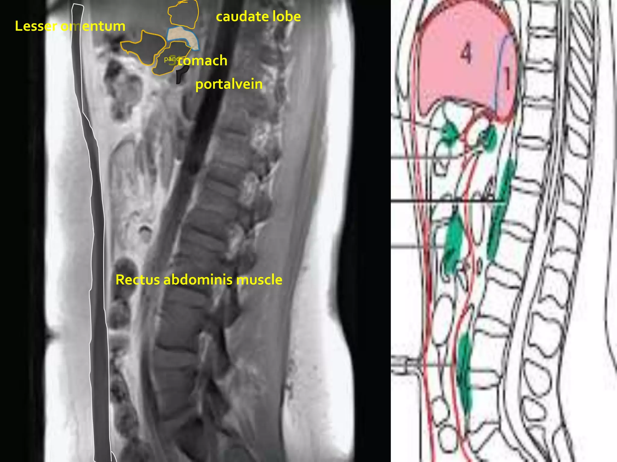 caudate lobe
Lesser omentum

                   Stomach
                  panc


                         portalvein




            Rectus abdominis muscle
 