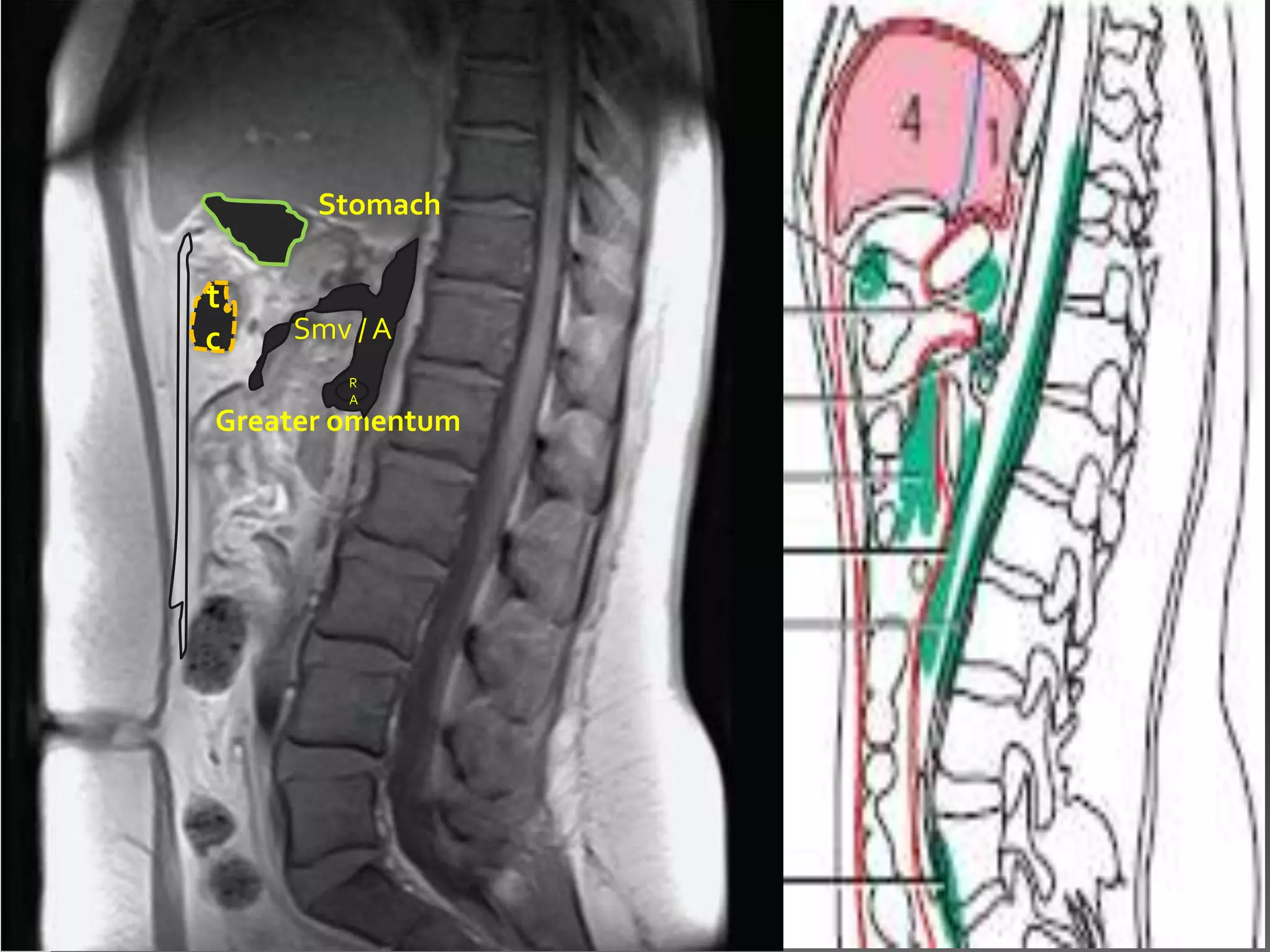 Stomach

t
c   Smv / A
        R
        A
Greater omentum
 