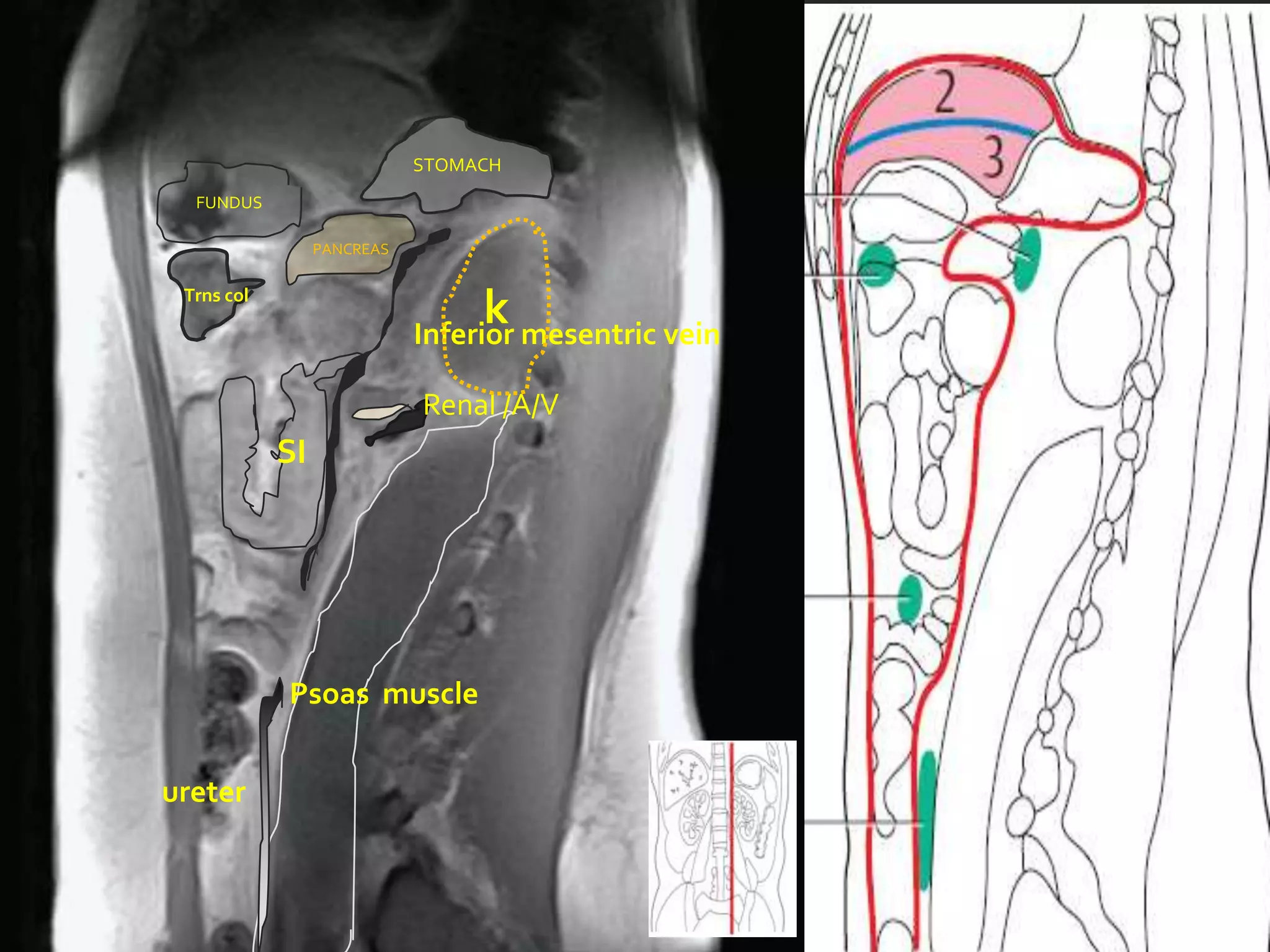 STOMACH
  FUNDUS

                 PANCREAS

 Trns col
                                 k
                            Inferior mesentric vein

                            Renal /A/V
            SI




            Psoas muscle


ureter
 