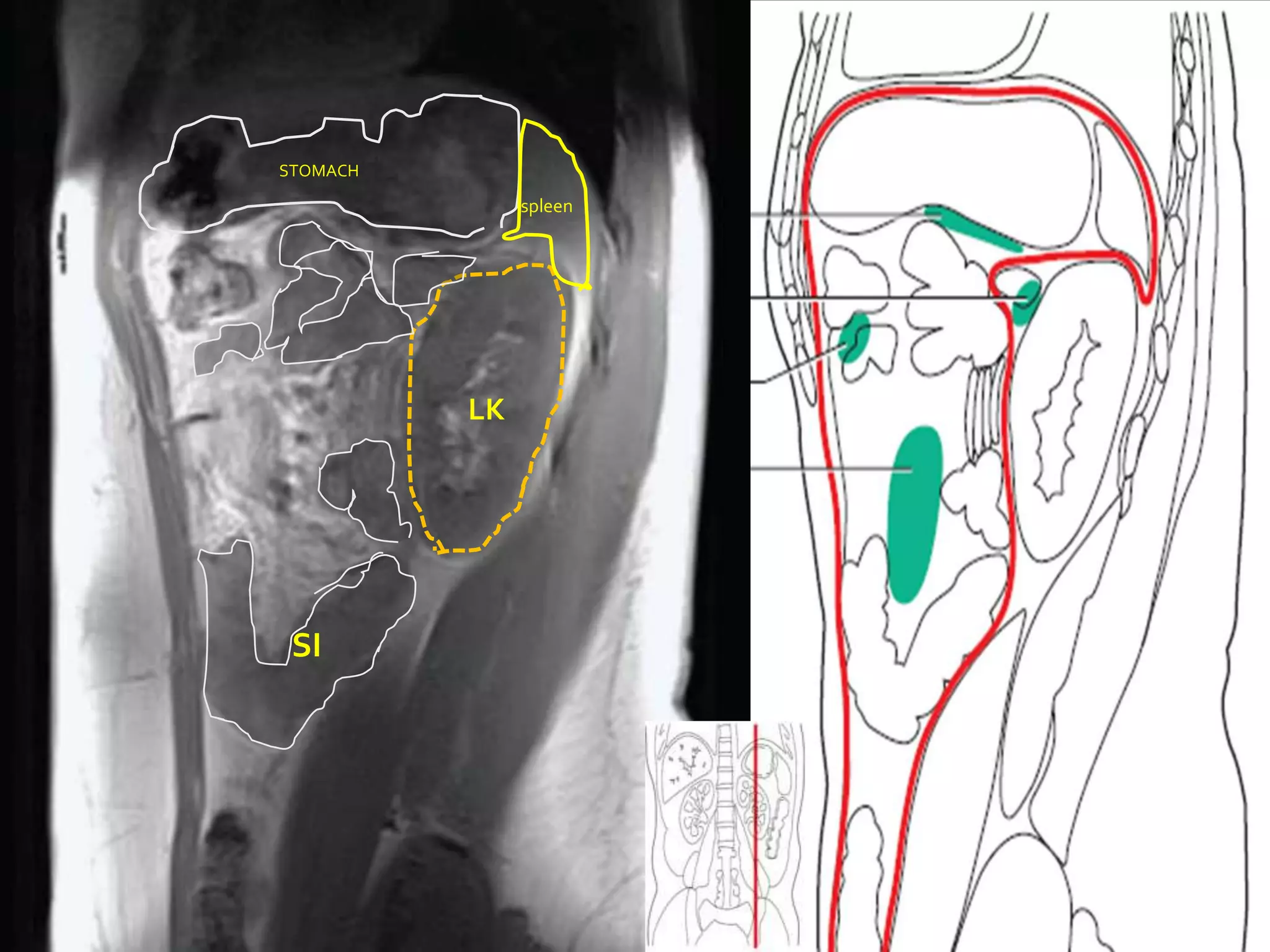 H
STOMACH

               spleen




          LK




 SI
 