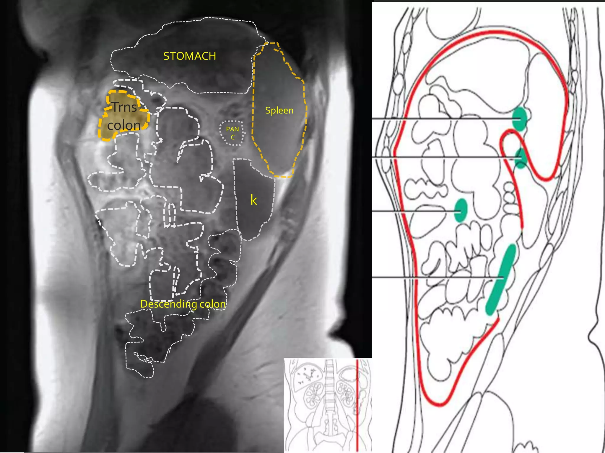 STOMACH



 Trns                            Spleen
colon                  PAN
                        C




                             k




    Descending colon
 