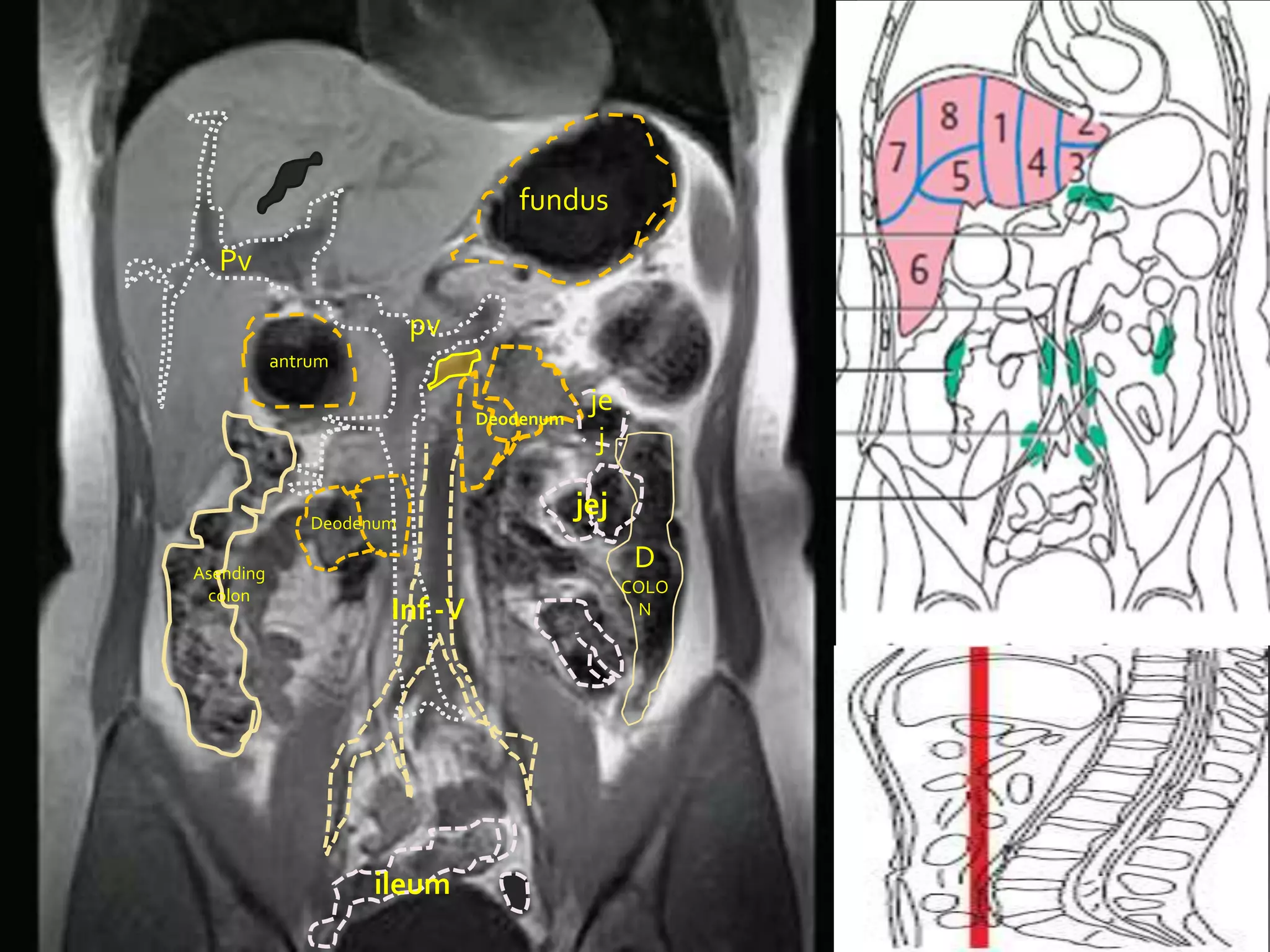 fundus
  Pv

                          pv
           antrum

                               Deodenum
                                           je
                                            j

               Deodenum
                                          jej

Asending
                                                 D
 colon                                          COLO
                      Inf -V                     N




                    ileum
 