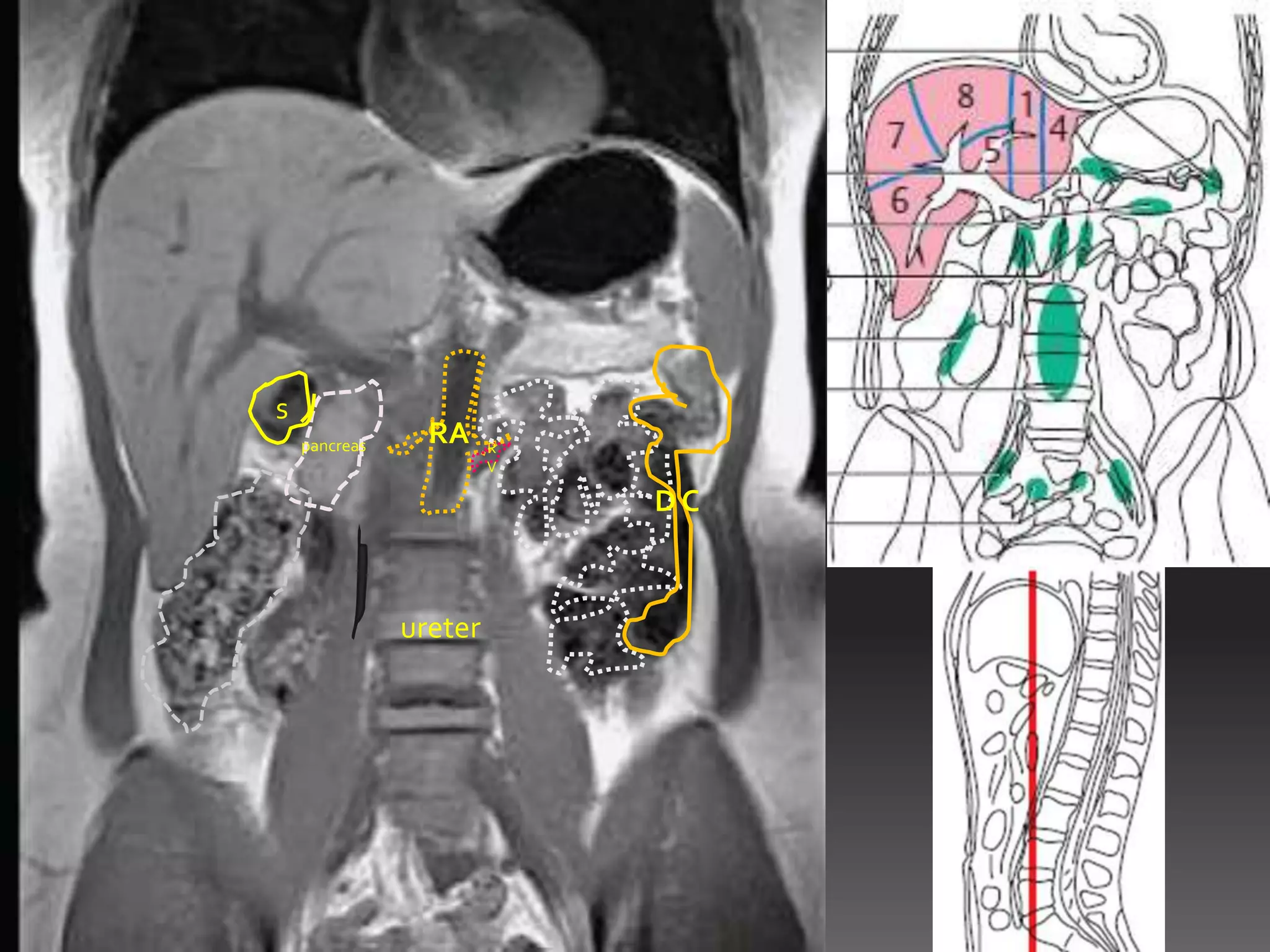 s
    pancreas     RA     R
                        V

                            DC


               ureter
 