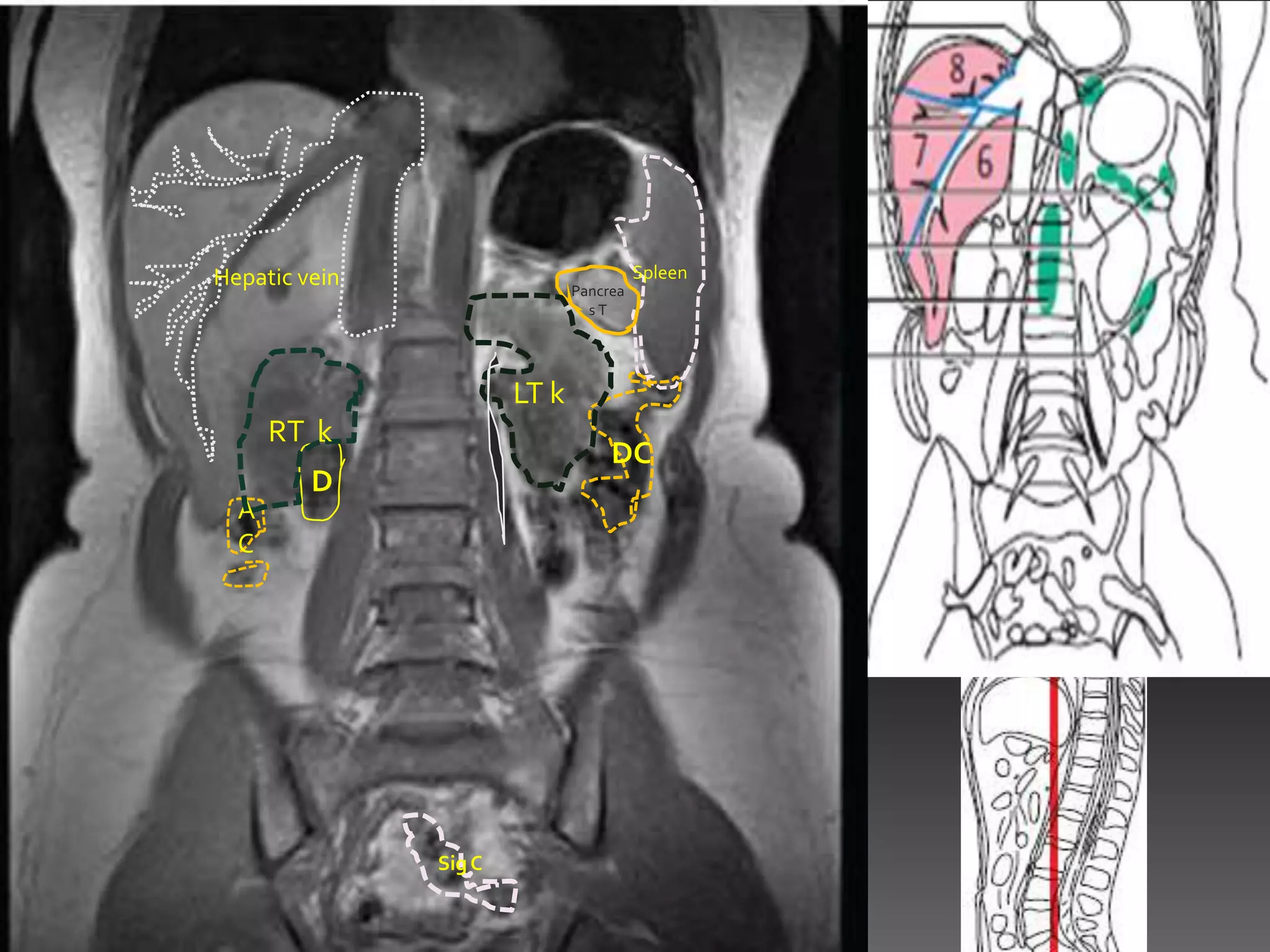 Hepatic vein                            Spleen
                              Pancrea
                                sT




                       LT k
      RT k
                                   DC
         D
  A
  C




               Sig C
 