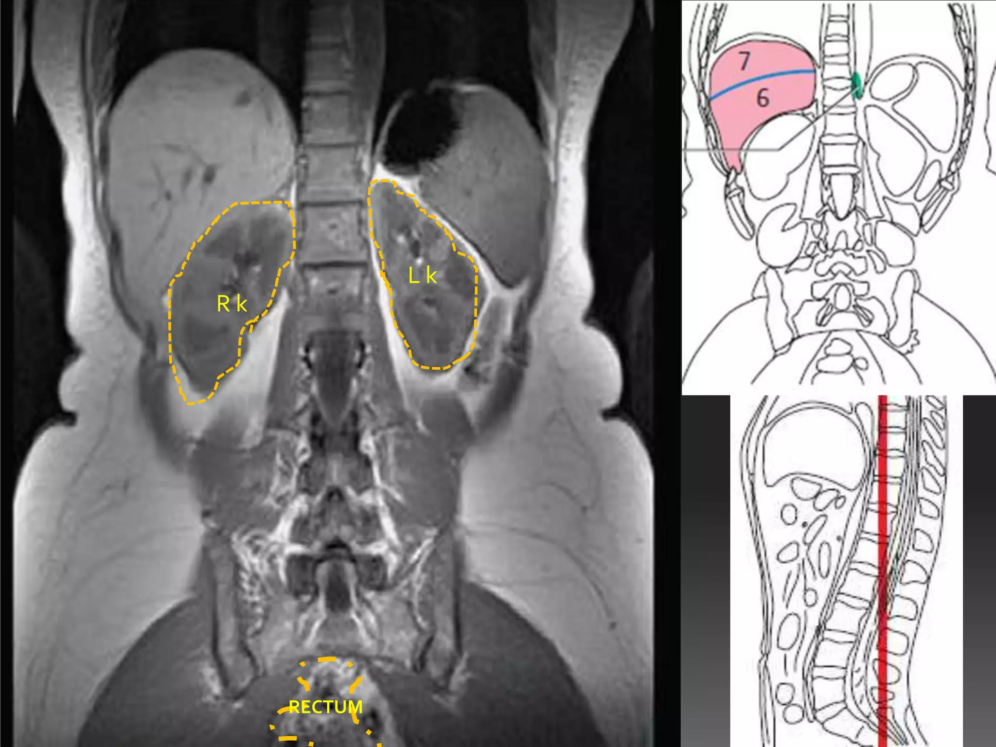 Lk
Rk




     RECTUM
 