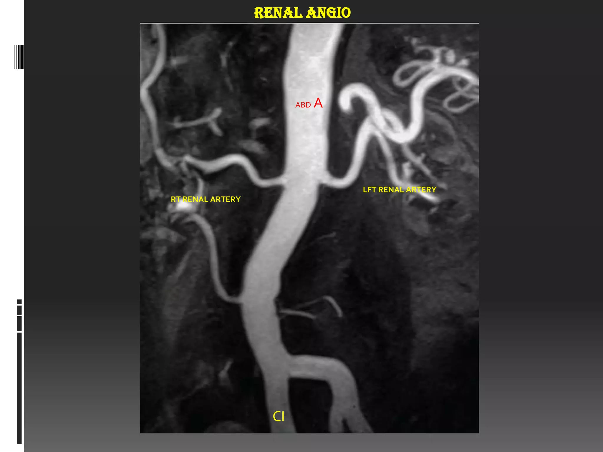 RENAL ANGIO




                         ABD   A




                                   LFT RENAL ARTERY
RT RENAL ARTERY




                    CI
 