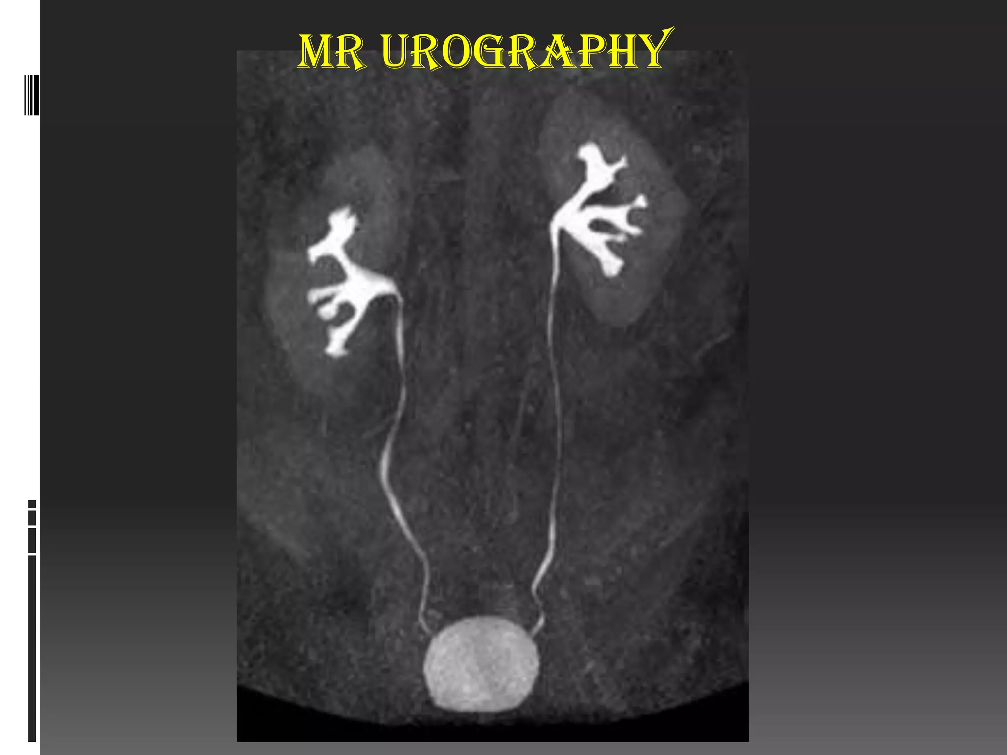 MR urography
 