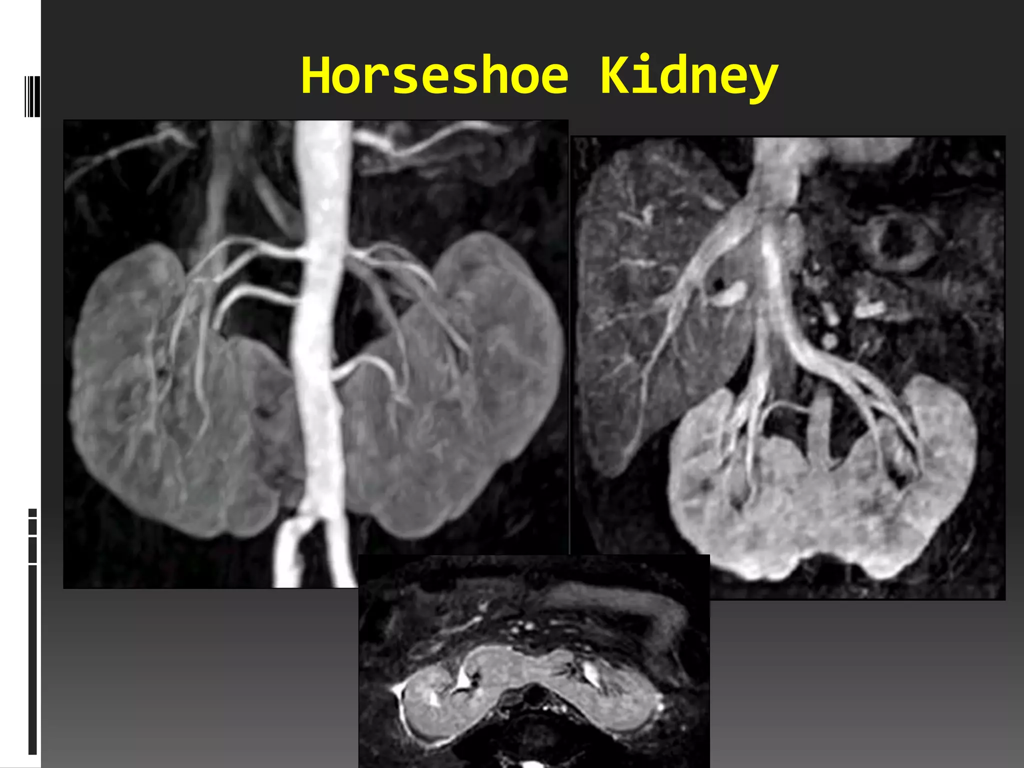 Horseshoe Kidney
 
