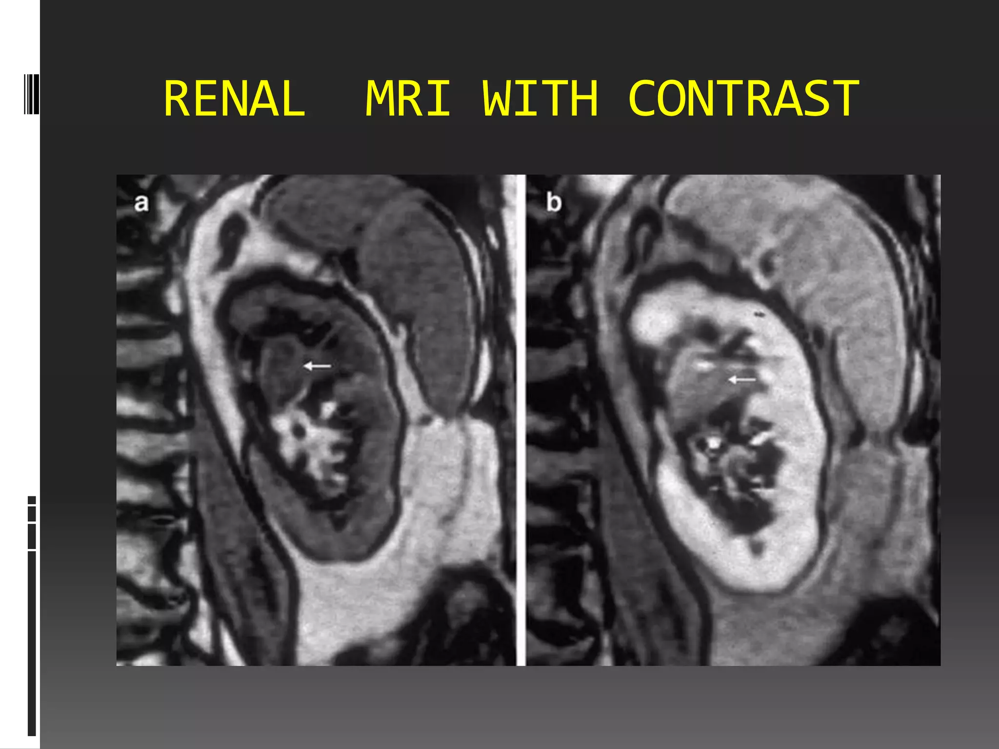 RENAL   MRI WITH CONTRAST
 