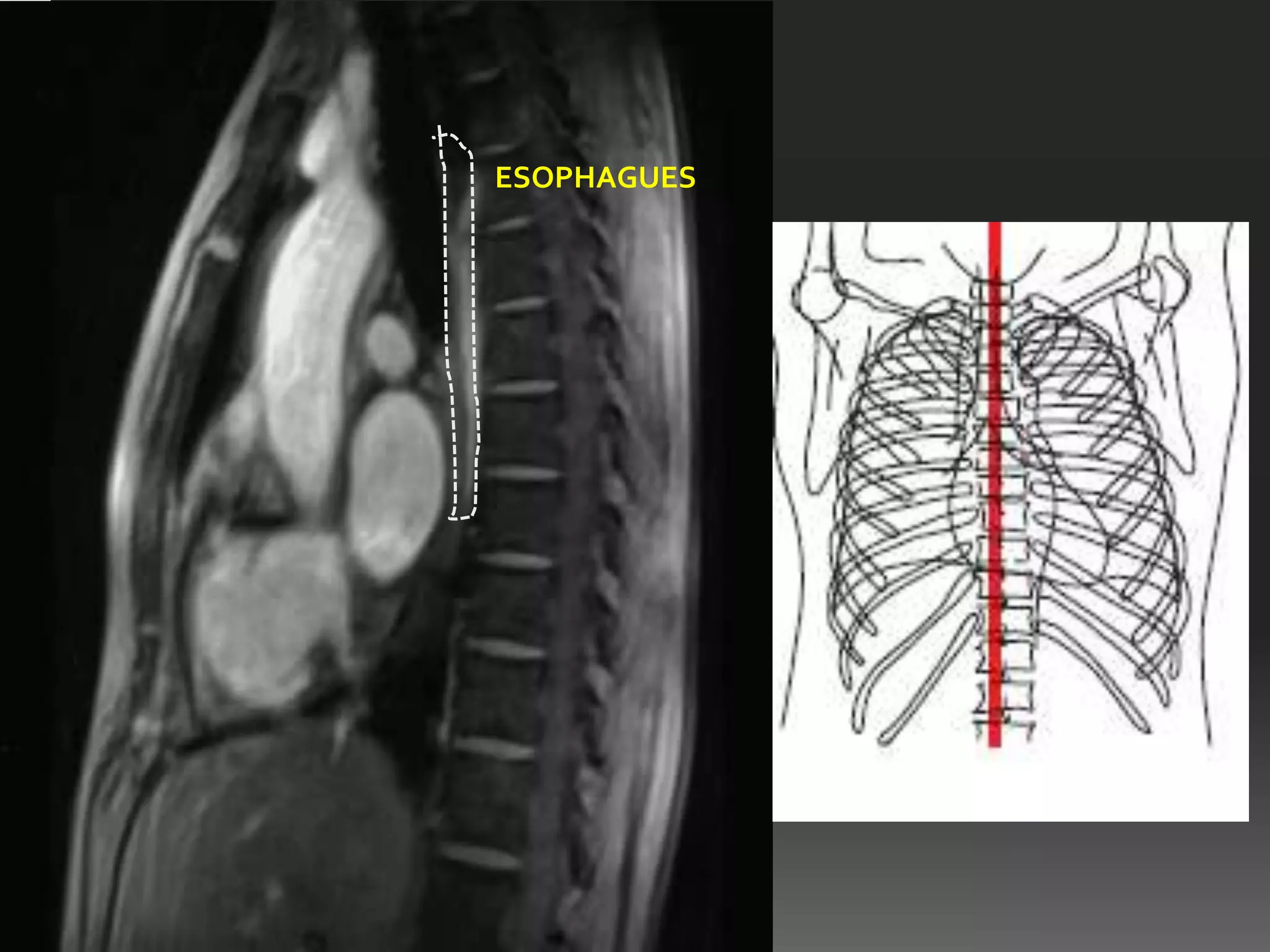 ESOPHAGUES
 