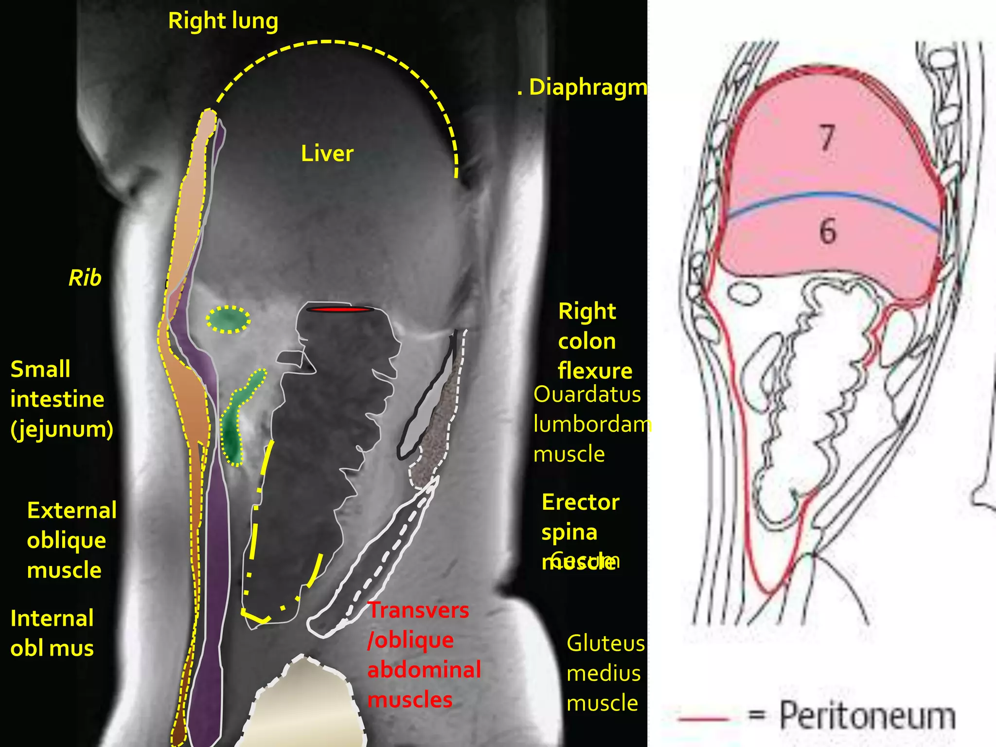 Right lung

                                             . Diaphragm

                         Liver




     Rib
                                                Right
                                                colon
Small                                           flexure
intestine                                     Ouardatus
(jejunum)                                     lumbordam
                                              muscle

 External                                      Erector
 oblique                                       spina
 muscle                                         Cecum
                                               muscle

Internal                         Transvers
obl mus                          /oblique        Gluteus
                                 abdominal       medius
                                 muscles         muscle
 