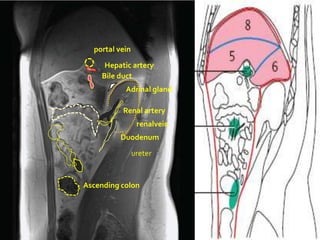 `
      portal vein

         Hepatic artery
        Bile duct
               Adrinal gland

              Renal artery
                     renalvein
             Duodenum
                    ureter



    Ascending colon
 