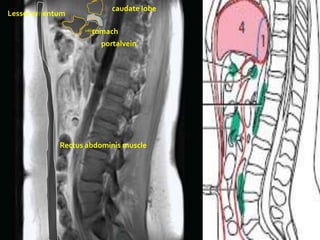 caudate lobe
Lesser omentum

                   Stomach
                  panc


                         portalvein




            Rectus abdominis muscle
 