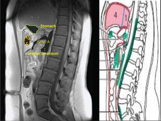 Stomach

t
c   Smv / A
        R
        A
Greater omentum
 