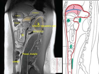 STOMACH
  FUNDUS

                 PANCREAS

 Trns col
                                 k
                            Inferior mesentric vein

                            Renal /A/V
            SI




            Psoas muscle


ureter
 