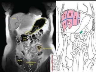Rt lobe




                                STOMACH




                  Trans
                  colon




                                          Sig moid colon




          cecum
                      Rectus abdominis
                           muscle
 
