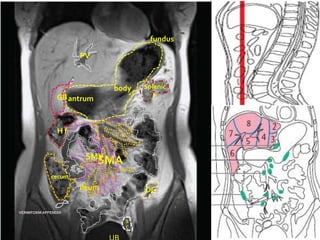 fundus

                     PV



                             body     Splenic
                GB antrum                F




                Hf


                       SMV
                            SMA
             cecum
                     ileum            DC

VERMIFORM APPENDIX

                                  S
                                  C
 