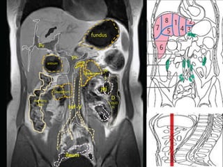fundus
  Pv

                          pv
           antrum

                               Deodenum
                                           je
                                            j

               Deodenum
                                          jej

Asending
                                                 D
 colon                                          COLO
                      Inf -V                     N




                    ileum
 