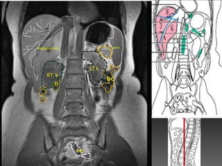 Hepatic vein                            Spleen
                              Pancrea
                                sT




                       LT k
      RT k
                                   DC
         D
  A
  C




               Sig C
 