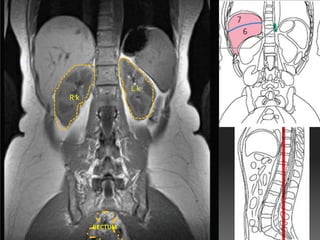 Lk
Rk




     RECTUM
 