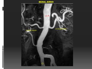 RENAL ANGIO




                         ABD   A




                                   LFT RENAL ARTERY
RT RENAL ARTERY




                    CI
 