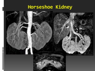 Horseshoe Kidney
 