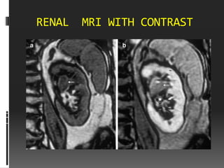 RENAL   MRI WITH CONTRAST
 
