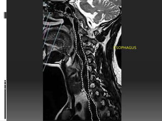ESOPHAGUS
 
