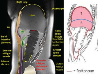 Right lung

                                             . Diaphragm

                         Liver




     Rib
                                                Right
                                                colon
Small                                           flexure
intestine                                     Ouardatus
(jejunum)                                     lumbordam
                                              muscle

 External                                      Erector
 oblique                                       spina
 muscle                                         Cecum
                                               muscle

Internal                         Transvers
obl mus                          /oblique        Gluteus
                                 abdominal       medius
                                 muscles         muscle
 