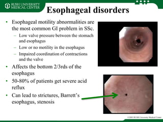 Esophageal disorders
©2003 RUSH University Medical Center
• Esophageal motility abnormalities are
the most common GI problem in SSc.
– Low valve pressure between the stomach
and esophagus
– Low or no motility in the esophagus
– Impaired coordination of contractions
and the valve
• Affects the bottom 2/3rds of the
esophagus
• 50-80% of patients get severe acid
reflux
• Can lead to strictures, Barrett’s
esophagus, stenosis
 