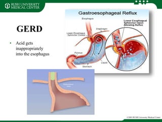 GERD
• Acid gets
inappropriately
into the esophagus
©2003 RUSH University Medical Center
 