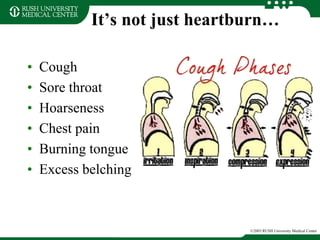 It’s not just heartburn…
• Cough
• Sore throat
• Hoarseness
• Chest pain
• Burning tongue
• Excess belching
©2003 RUSH University Medical Center
 