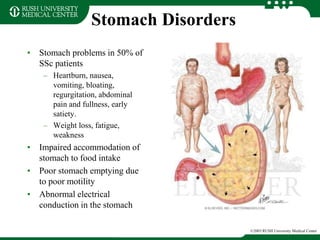Stomach Disorders
• Stomach problems in 50% of
SSc patients
– Heartburn, nausea,
vomiting, bloating,
regurgitation, abdominal
pain and fullness, early
satiety.
– Weight loss, fatigue,
weakness
• Impaired accommodation of
stomach to food intake
• Poor stomach emptying due
to poor motility
• Abnormal electrical
conduction in the stomach
©2003 RUSH University Medical Center
 