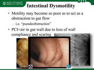 Intestinal Dysmotility
• Motility may become so poor as to act as a
obstruction to gut flow
– i.e. “pseudoobstruction”
• PCI=air in gut wall due to loss of wall
compliance and scaring.
©2003 RUSH University Medical Center
 