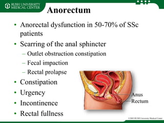 Anorectum
• Anorectal dysfunction in 50-70% of SSc
patients
• Scarring of the anal sphincter
– Outlet obstruction constipation
– Fecal impaction
– Rectal prolapse
• Constipation
• Urgency
• Incontinence
• Rectal fullness ©2003 RUSH University Medical Center
Anus
Rectum
 