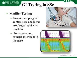 GI Testing in SSc
• Motility Testing
– Assesses esophageal
contractions and lower
esophageal sphincter
function
– Uses a pressure
catheter inserted into
the nose
©2003 RUSH University Medical Center
 