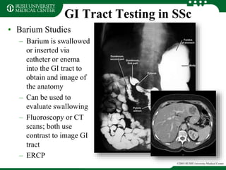 GI Tract Testing in SSc
• Barium Studies
– Barium is swallowed
or inserted via
catheter or enema
into the GI tract to
obtain and image of
the anatomy
– Can be used to
evaluate swallowing
– Fluoroscopy or CT
scans; both use
contrast to image GI
tract
– ERCP
©2003 RUSH University Medical Center
 